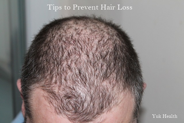 Yuk Health Tips To Prevent Hair Loss