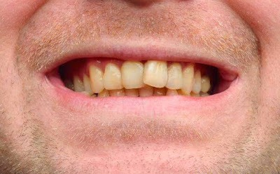 Tác hại của răng ố vàng