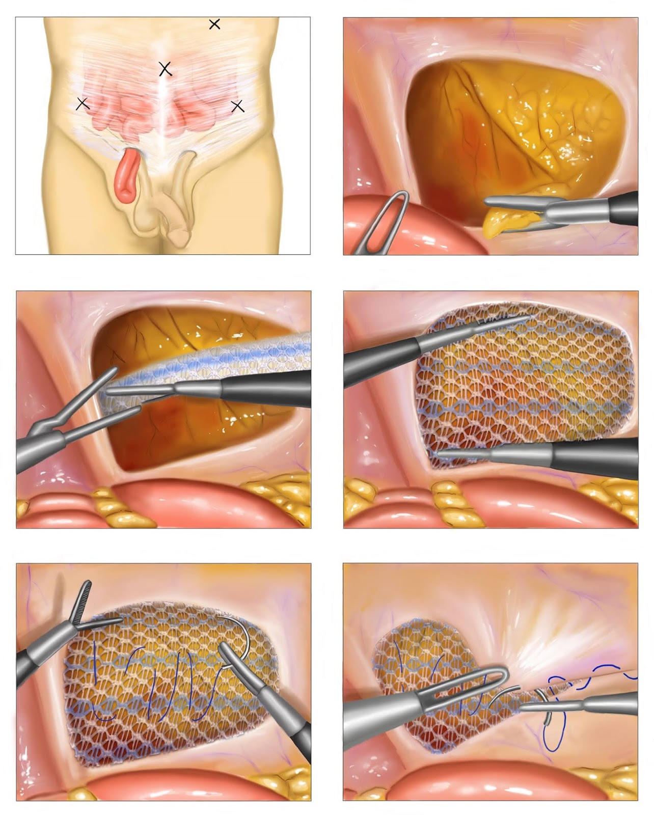 abdominal hernia surgery