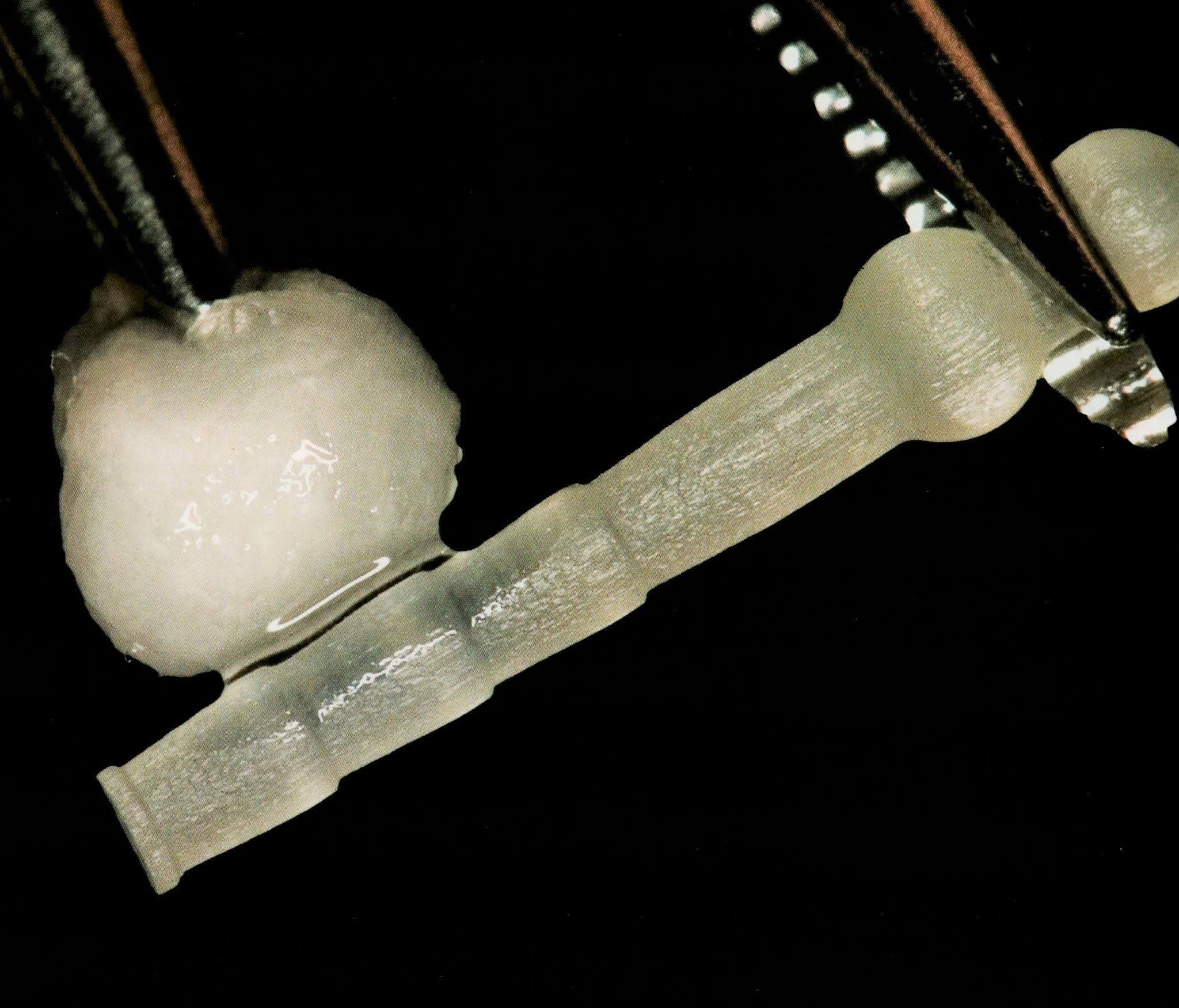 How to cement a fiber post ? Dental Esthetics