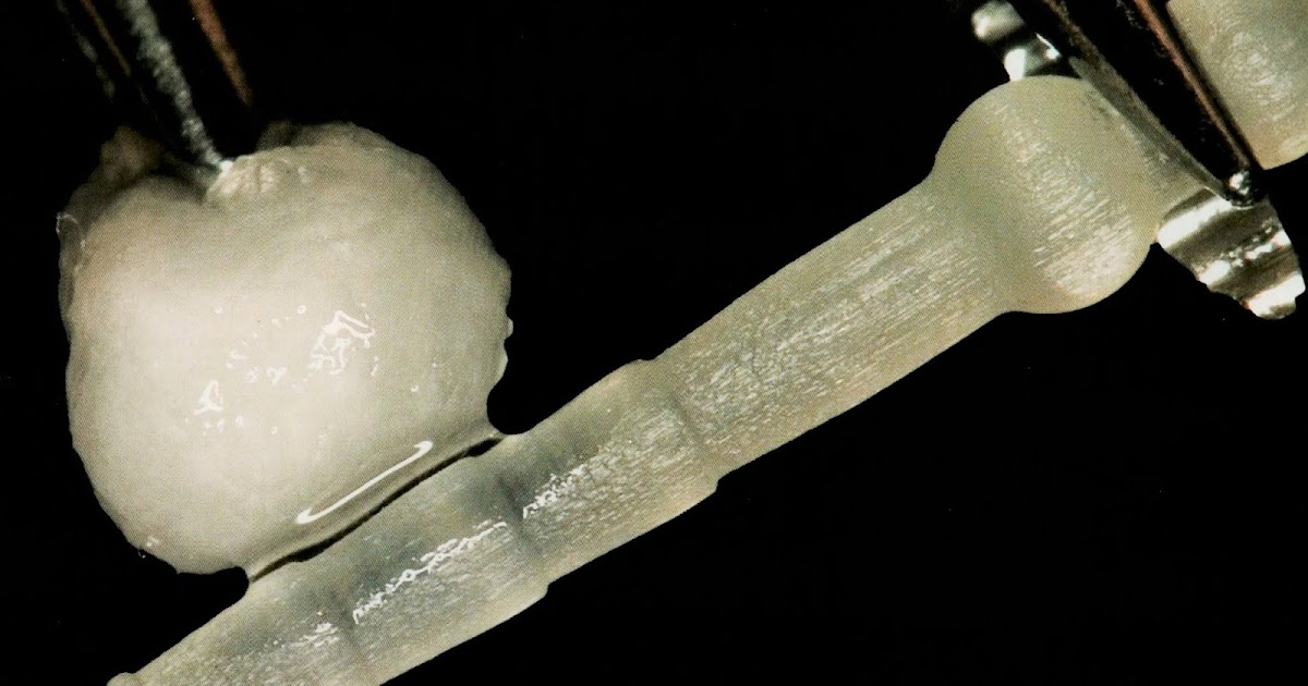 How to cement a fiber post ? Dental Esthetics