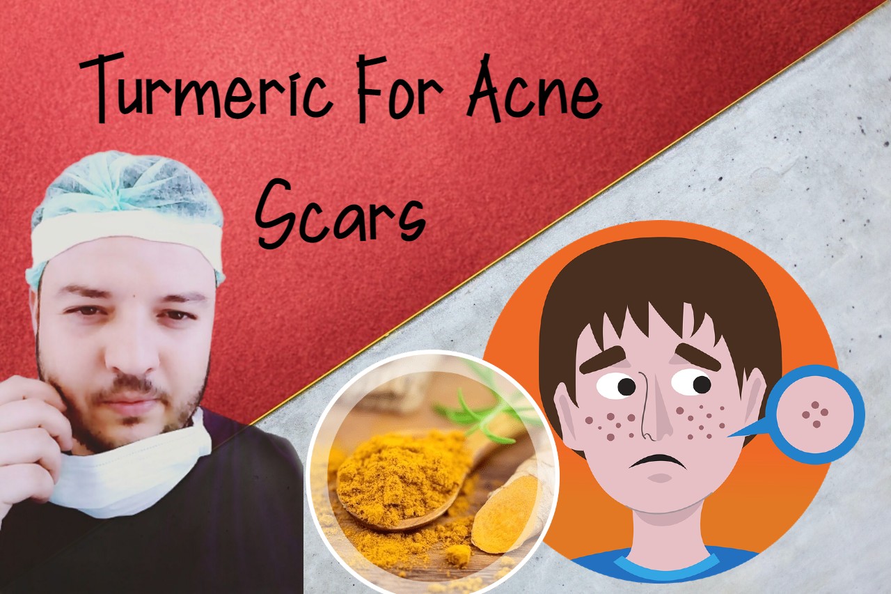 Does Turmeric Help Acne Scars? Best Homemade Turmeric Face Masks