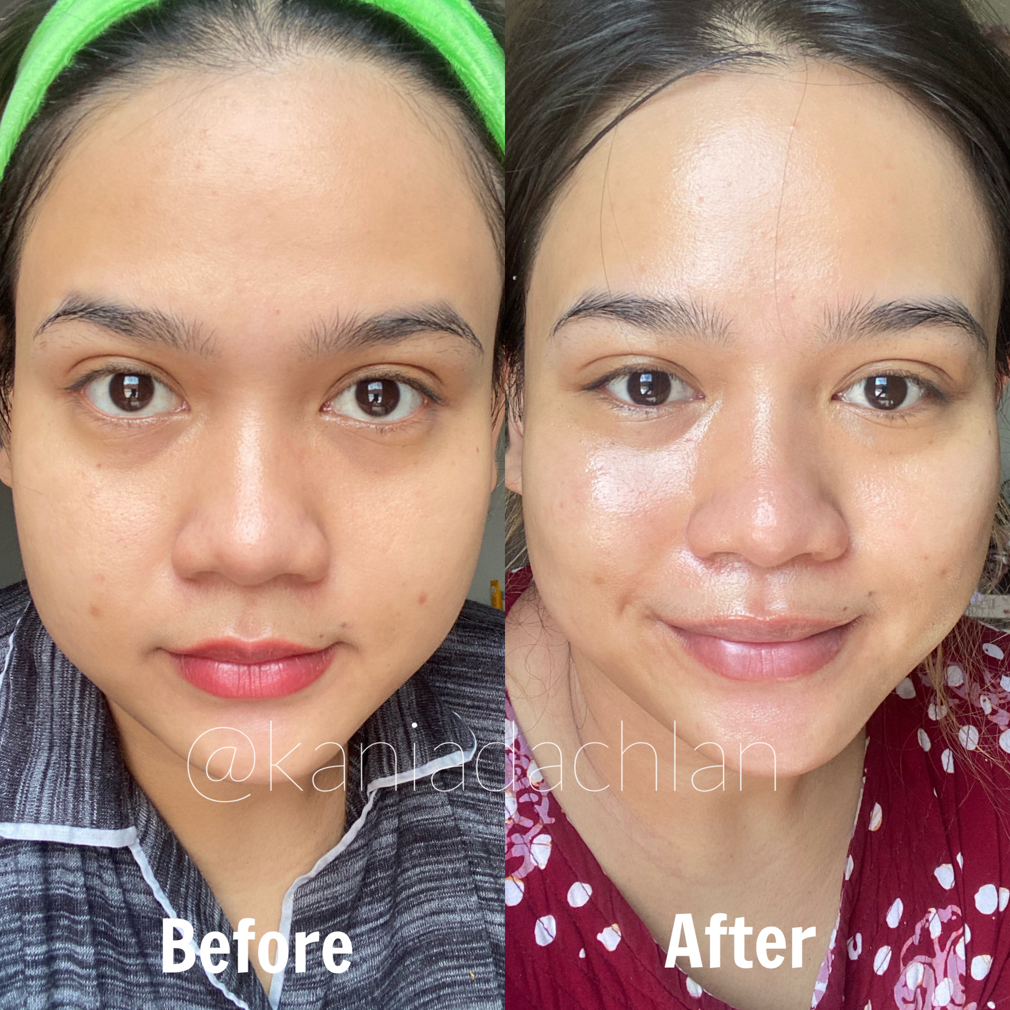 REVIEW KLINIK ATHENA BANDUNG Kania Dachlan