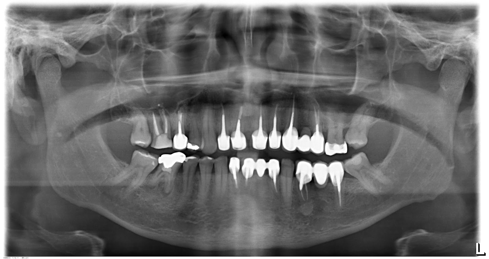 Por Dentro do Dente Radiografia Panorâmica Por Dentro do Dente Radiografia Panorâmica