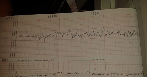 Ctg Wie Hoch Müssen Die Wehen Sein Bilder Zu Wie Sehen Wehen Auf Dem Ctg Aus
