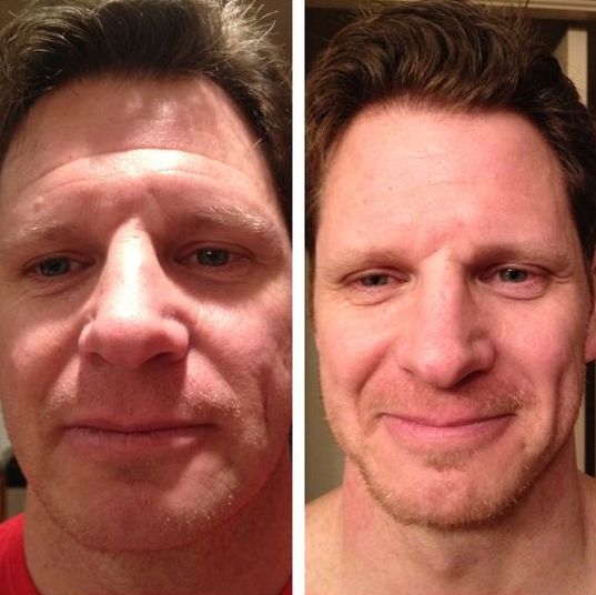 Natural Face Lifting With Facial Gymnastics Effective NonSurgical