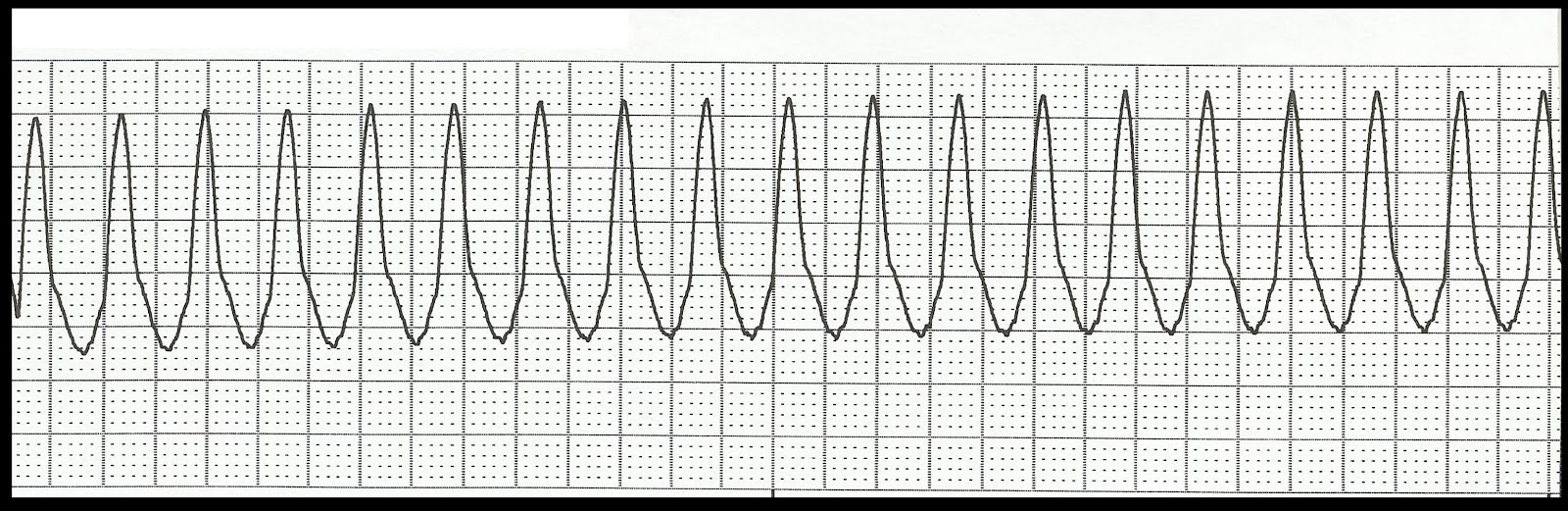 Ekg Practice Strips Printable Customize And Print Ekg Practice Strips Printable Customize And Print