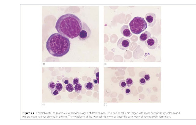Erythroblasts (normoblasts) at varying stages of development. The earlier cells are larger, with more basophilic cytoplasm and a more open nuclear chromatin pattern. The cytoplasm of the later cells is more eosinophilic as a result of haemoglobin formation.