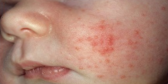 Cara Mengobati Biang Keringat Di Wajah dengan Tepung Jagung | Tips