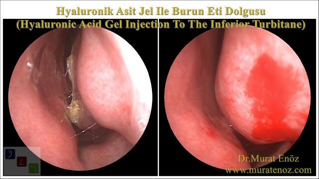 Boş burun sendromu tedavisinde Hyaluronik Asit dolgusu - Burun eti dolgusu - Treatment of Empty nose syndrome with hyaluronic acid filler - Boş burun - Geniş burun boşluğu sendromu - Burun eti büyütülmesi - Empty Nose Syndrome (ENS) - Hyaluronic acid gel in the treatment of empty nose syndrome - Empty Nose Syndrome - Treatment of Empty Nose Syndrome - Treatment of Empty Nose Syndrome in Istanbul