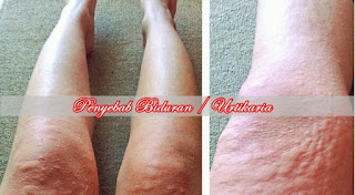 Cara Menyembuhkan Gatal Biduran Yang Sering Kambuh Cara Menyembuhkan Gatal Biduran Yang Sering Kambuh