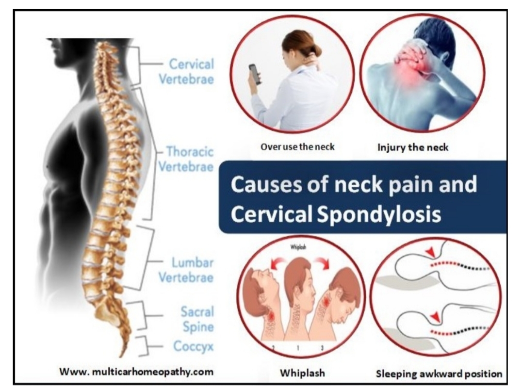 CERVICAL SPONDYLOSIS cervical-spondylosis