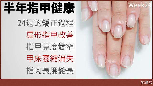 指甲矯正成完美甲型的例子｜咬指甲用24周變健康｜用90週變超完美
