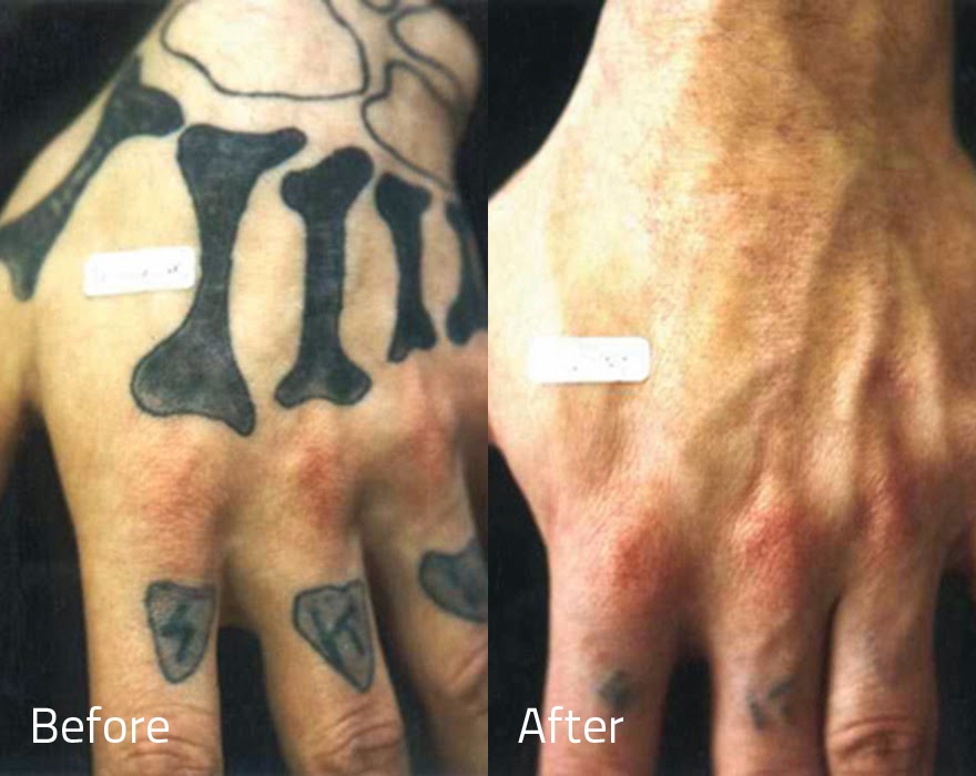 Erase Tattoo Removal May 2014