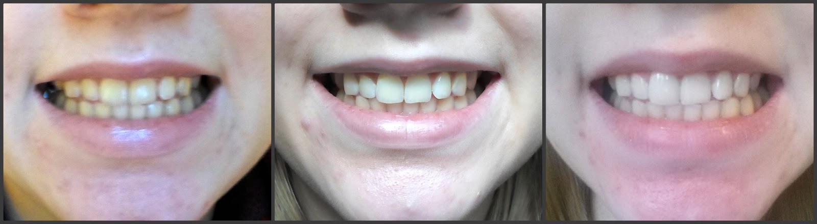 teeth-treat-how-to-use-crest-white-strips-brush-teeth