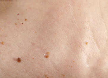  Home Remedies to Remove Skin Tags