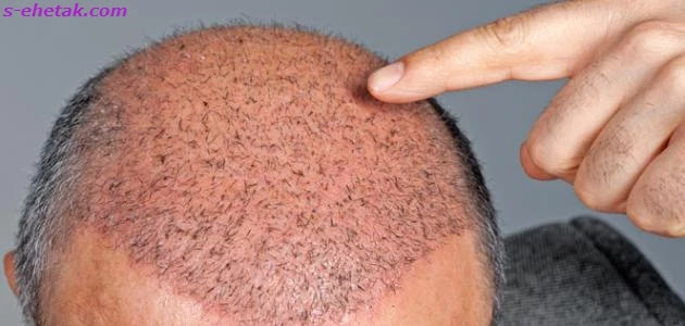 انواع زراعة الشعر