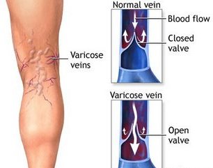 care a facut dei varicoza