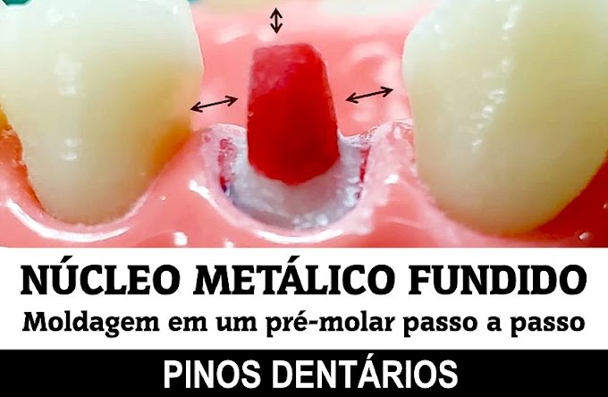 NÚCLEO METÁLICO FUNDIDO: Moldagem em um pré-molar passo a passo