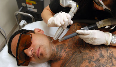 Removing Tattoos