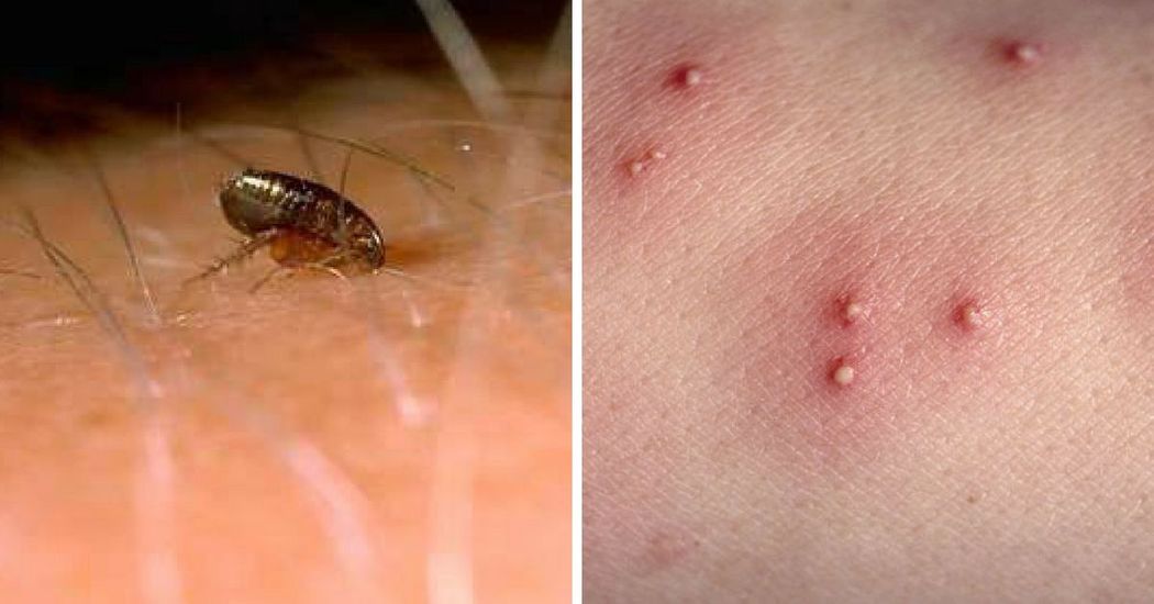 How To Recognize All 12 Most Common Bug Bites