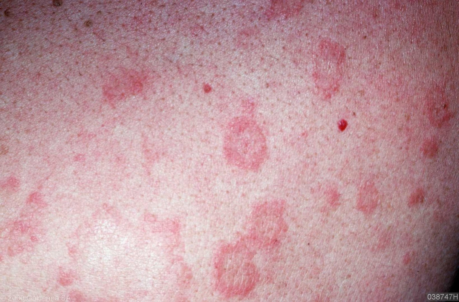 Skin Disease Types Tinea Versicolor