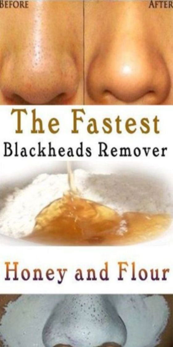 Blackhead Remover Best Natural Ways to Remove Acne For Good