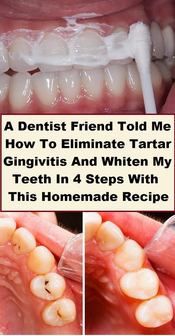 Eliminate Tartar, Gingivitis And Whiten Your Teeth With This Homemade Recipe wellness days