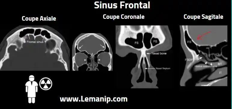 Anatomie Et Coupes Scanner Des Sinus frontal