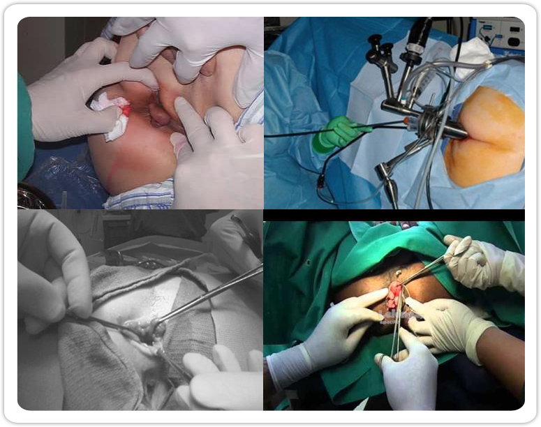 Cara Mengobati Penyakit Wasir Tanpa Operasi Dengan Penambahan Probiotik Ubatbuasir12 Over Blog Com