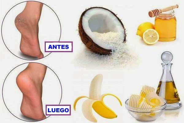 10 simples remedios caseros para talones agrietados ~ Remedios ...
