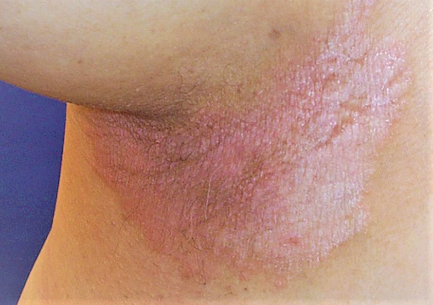 WISH UR HEALTH: PSORIASIS : Symptoms; Diagnosis; Types; Causes