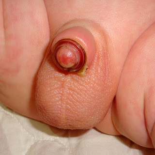 Plastibell Circumcision Device
