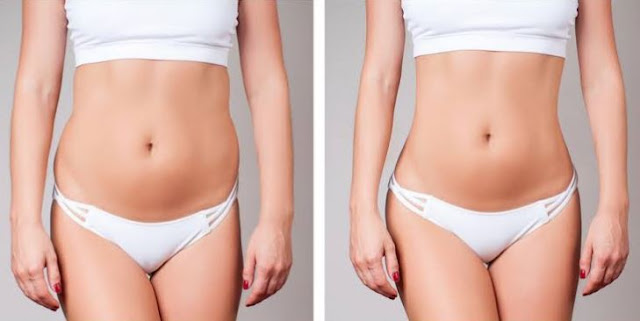 considerations before getting liposuction fat removal surgery lipo cosmetic surgeon
