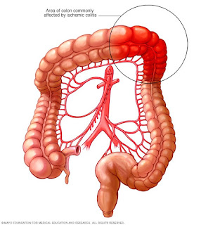 Colitis : बड़ी आंत की सूजन, कोलाइटिस के कारण और लक्षण