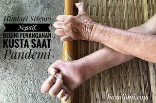 Hindari Stigma Negatif Kusta