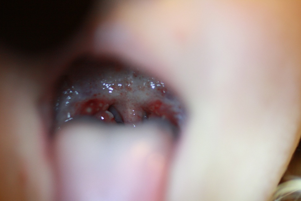 Blisters In Throat Pictures 113