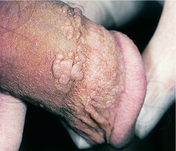 human papilloma virus genital)