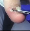 Black Head Removal (VIDEO) Pimple Popping