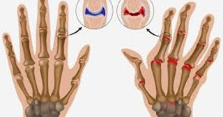 Asam urat aplikasi surat, pengobatan medis penyakit asam urat, oyong penyebab asam urat, apa obat nya penyakit asam urat, nilai normal asam urat kolesterol dan gula, www.cara mengobati penyakit asam urat, kaki bengkak akibat asam urat tinggi, sembuhkan bengkak asam urat, mengobati asam urat secara cepat, apakah asam urat bisa sembuh tanpa obat, obat herbal alami penyakit asam urat, asam urat tinggi, kadar asam urat yang normal menurut who