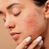 Consejos para eliminar el acné