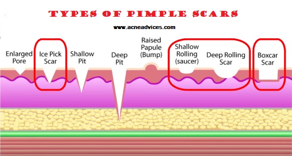 how to avoid and remove pimple scars
