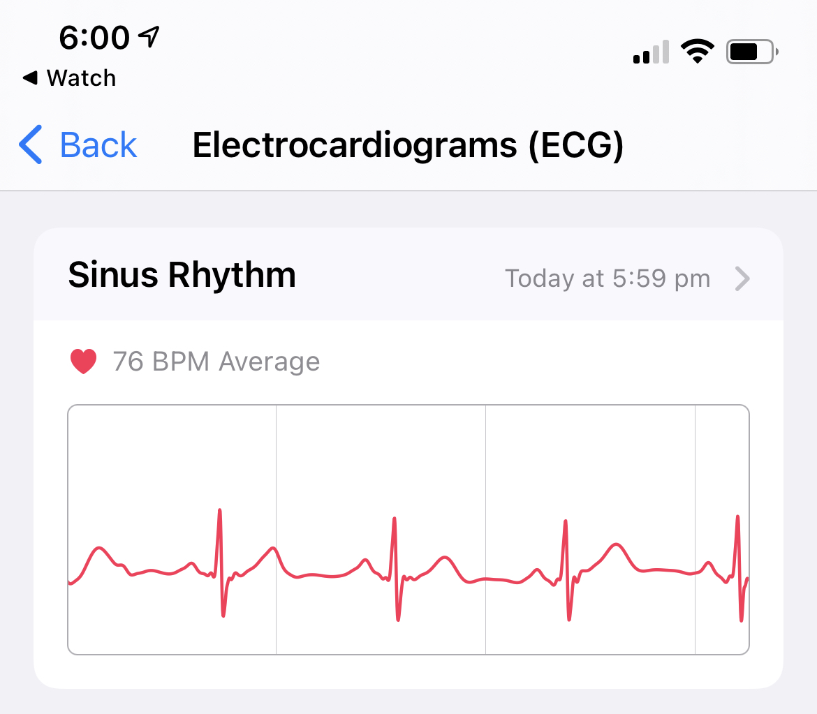 marxy's musing on technology Why ECG isn't enabled on the Apple Watch