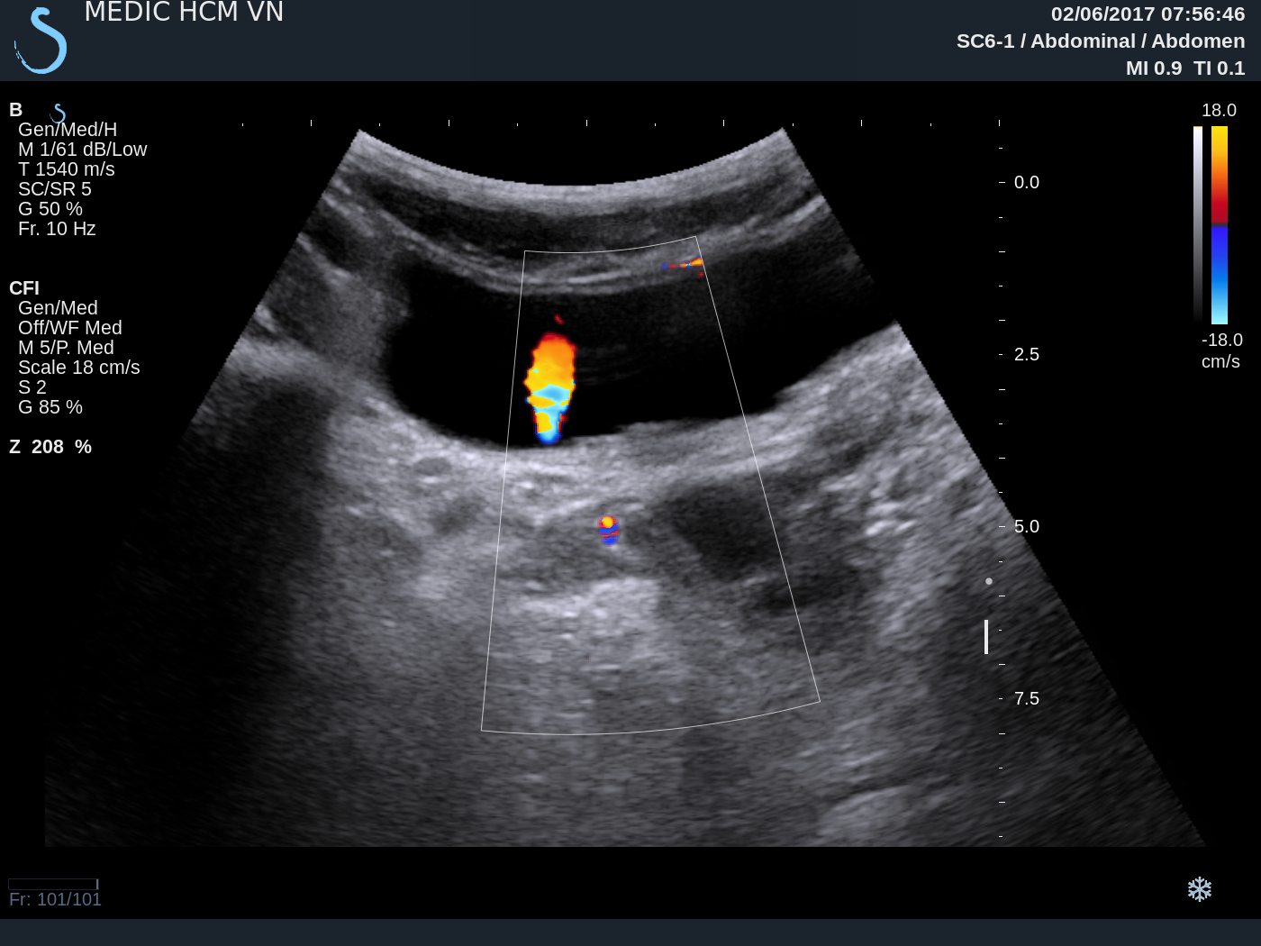 VIETNAMESE MEDIC ULTRASOUND CASE 436 SOLITARY KIDNEY, Dr PHAN THANH