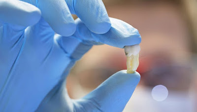 Phòng ngừa viêm nhiễm sau nhổ răng