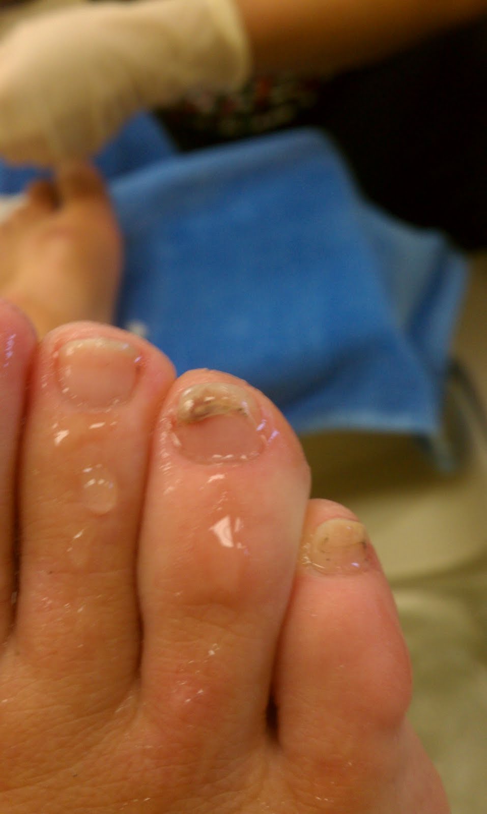 split toenail #11