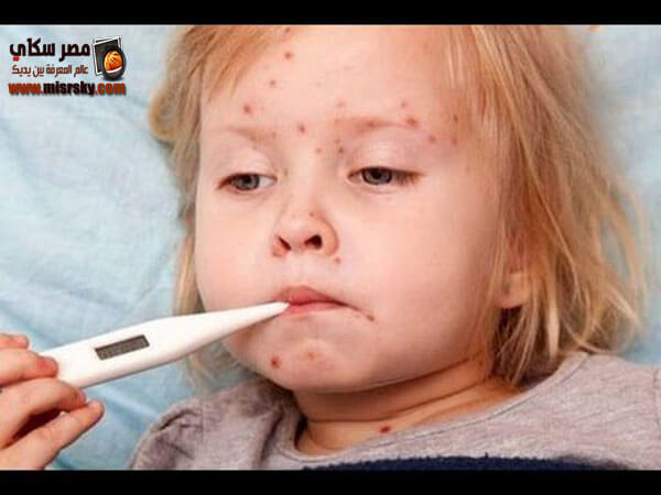 الحصبة الألمانية وكيفية الوقاية منها German Measles الحصبة الألمانية وكيفية الوقاية منها German Measles