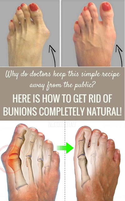 Here’s How To Get Rid Of Bunions Completely Natural!