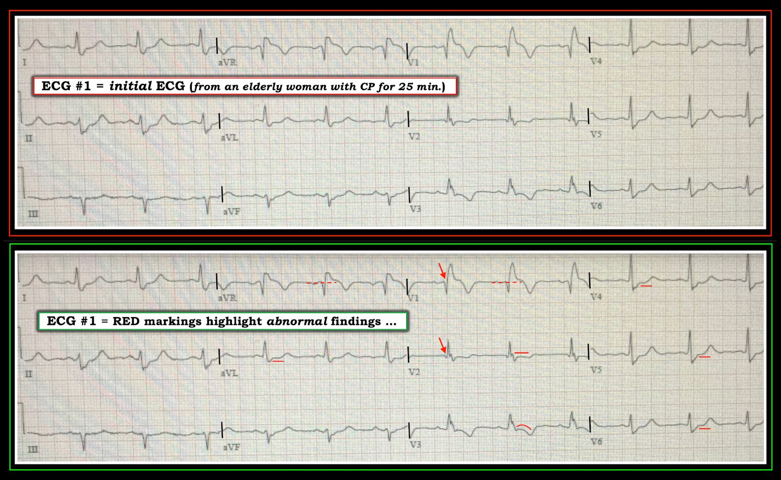 Dr. Smith's ECG Blog Chest Pain and RBBB. What do you think?