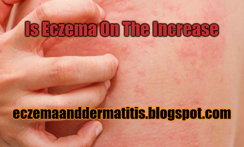 Is Eczema On The Increase Eczema and Dermatitis